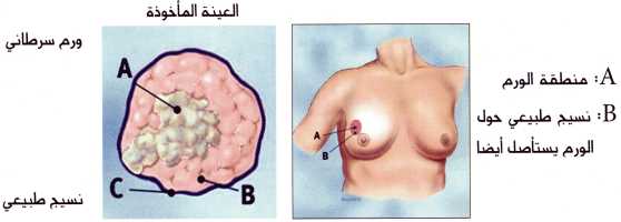 صور سرطان الثدي - اعراض واسباب سرطان الثدي 4032 4
