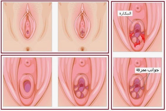 اين يقع غشاء البكارة - معلومات تهم كل فتاة عن غشاء البكارة 1994 1