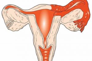 كيف اعرف ان فيني قرحه في الرحم , كيف التاكد من وجود قرحه في الرحم والاسباب والعلاج