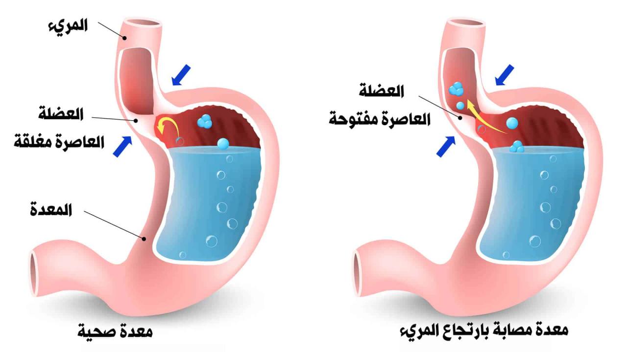 علاج الارتجاع المريئي , ارتجاع المرئ اسبابه وطرق علاجه