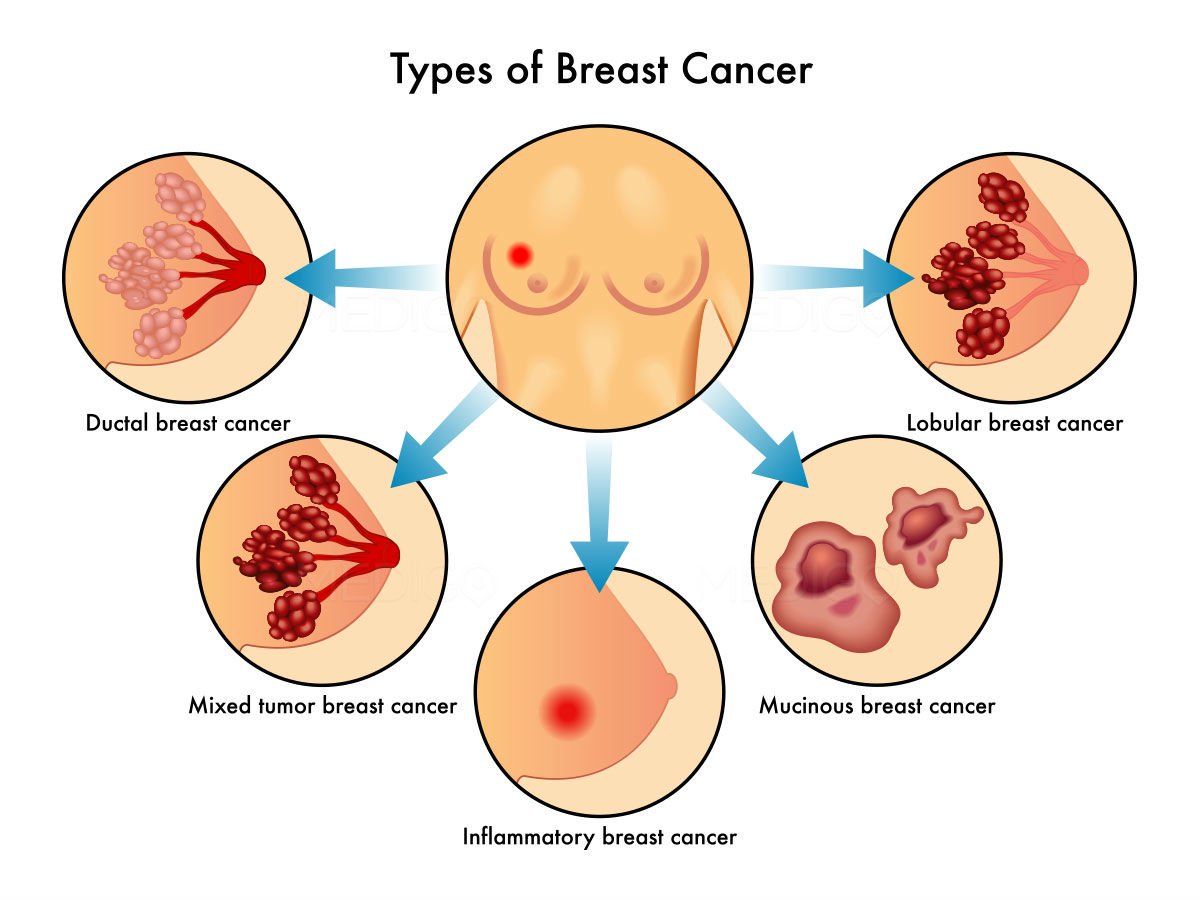 صور سرطان الثدي - اعراض واسباب سرطان الثدي 4032 11