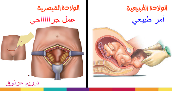 الحمل بعد الولادة القيصرية بشهرين - مخاطر الحمل بعد القيصري بشهرين 1146 1