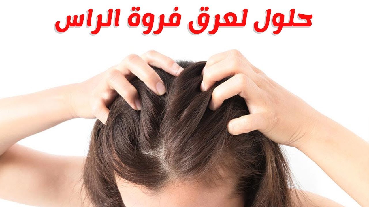 اسباب تعرق فروة الراس , هل تعاني من عرق في خصيلات شعرك