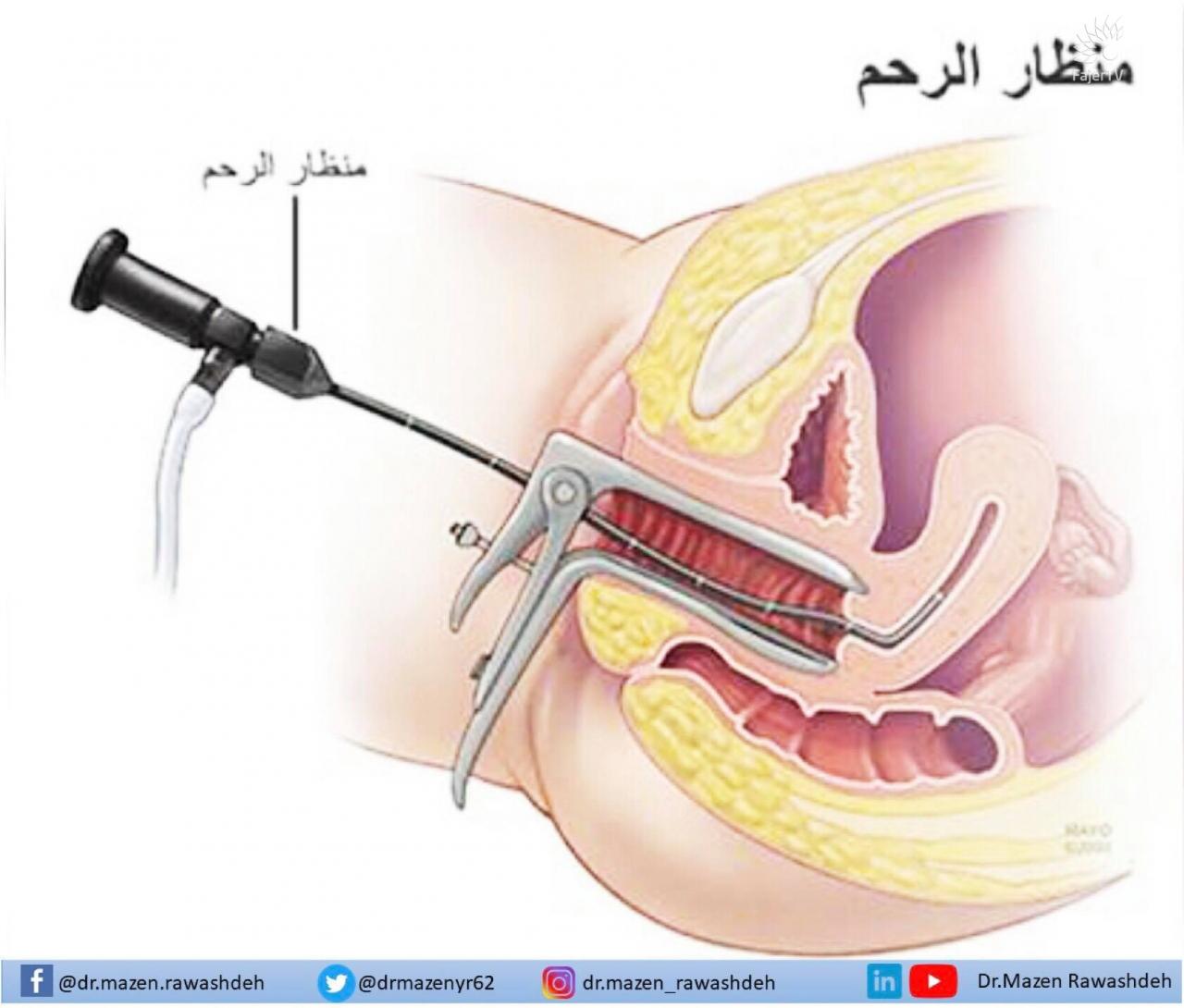 اشعة الصبغة للرحم - اشعات اضرارها كبيرة ويجب الاحتراس 1235 6