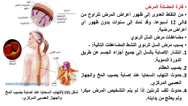 مرض السل اعراضه - امراض معدية تعرف عليها لتقي نفسك وعائلتك منها 1998 1