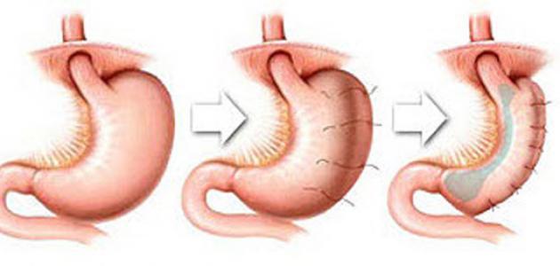 عمليه تكميم المعده اضرارها تعرف علي فوائد واضرار عمليه تكميم المعده