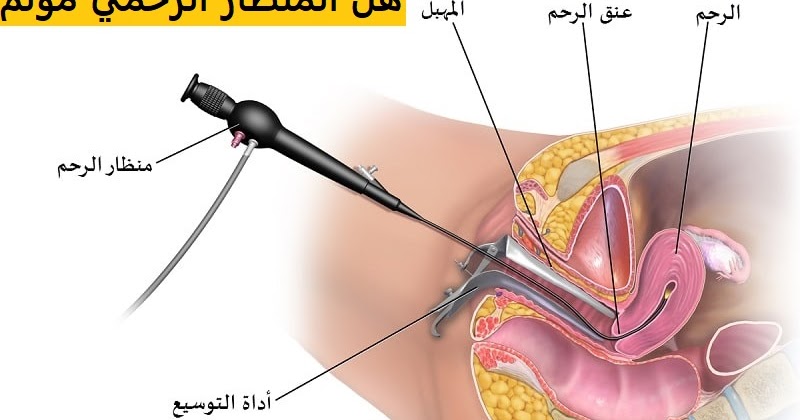 عملية منظار الرحم - اهم المعلومات عن عملية منظار الرحم 4010