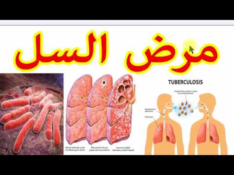 مرض السل اعراضه - امراض معدية تعرف عليها لتقي نفسك وعائلتك منها 1998 3