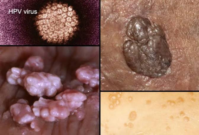 كيفية القضاء على فيروس Hpv - ماهو فيرس Hpv و كيف يصيب الانسان 7300 1