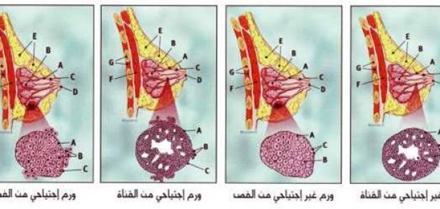 صور سرطان الثدي - اعراض واسباب سرطان الثدي 4032 5