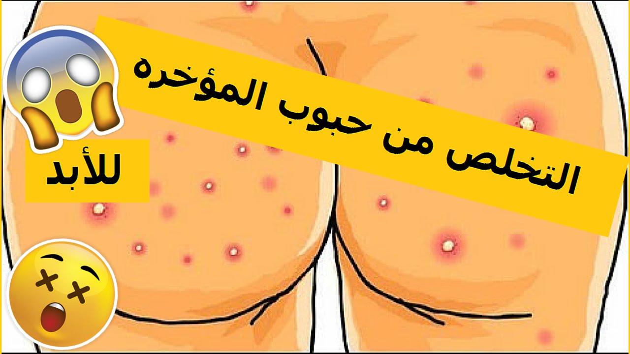 كيف اتخلص من حبوب المؤخرة , تخلصى من حبوب المؤخره بسهوله