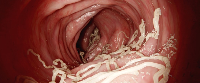 التخلص من ديدان البطن , في المنزل كيف تعالجي الاصابة بديدان في البطن